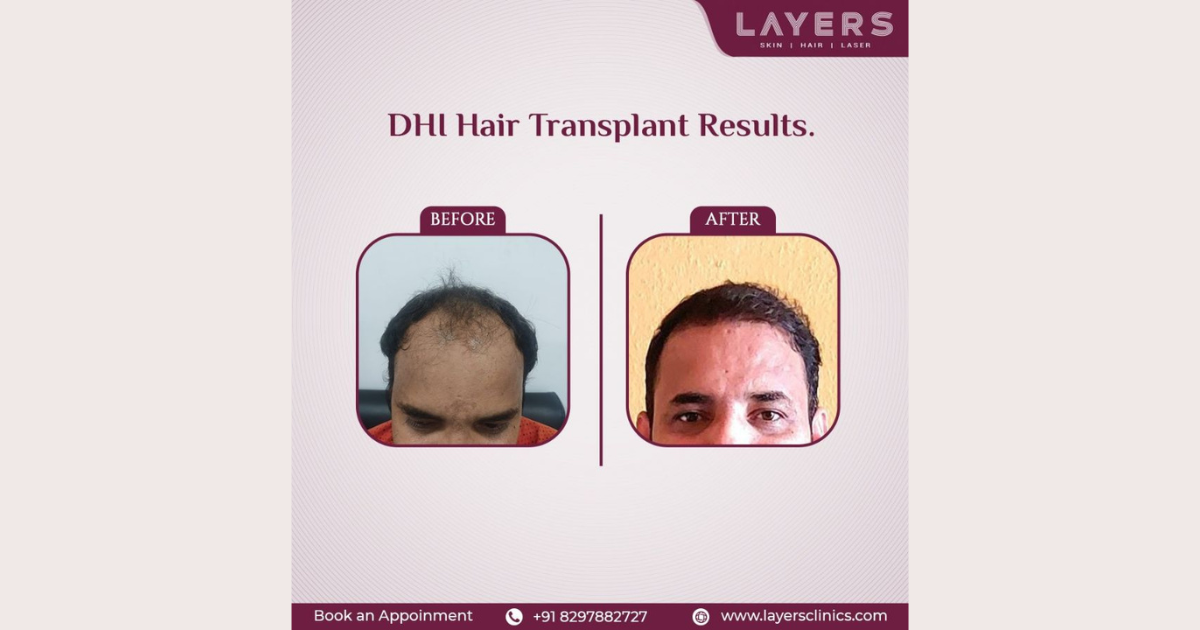 Layers, A Hair Transplant Clinic in Hyderabad, Implements Direct Hair Implantation (DHI) To Help Its Clients Tackle Premature Baldness